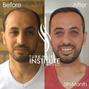 turk-hair-before-after-15